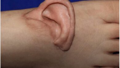 Ιατρική ομάδα στην Κίνα κατά τη διάρκεια της πρωτοποριακής μικροχειρουργικής επέμβασης μεταμόσχευσης αυτιού στο πόδι