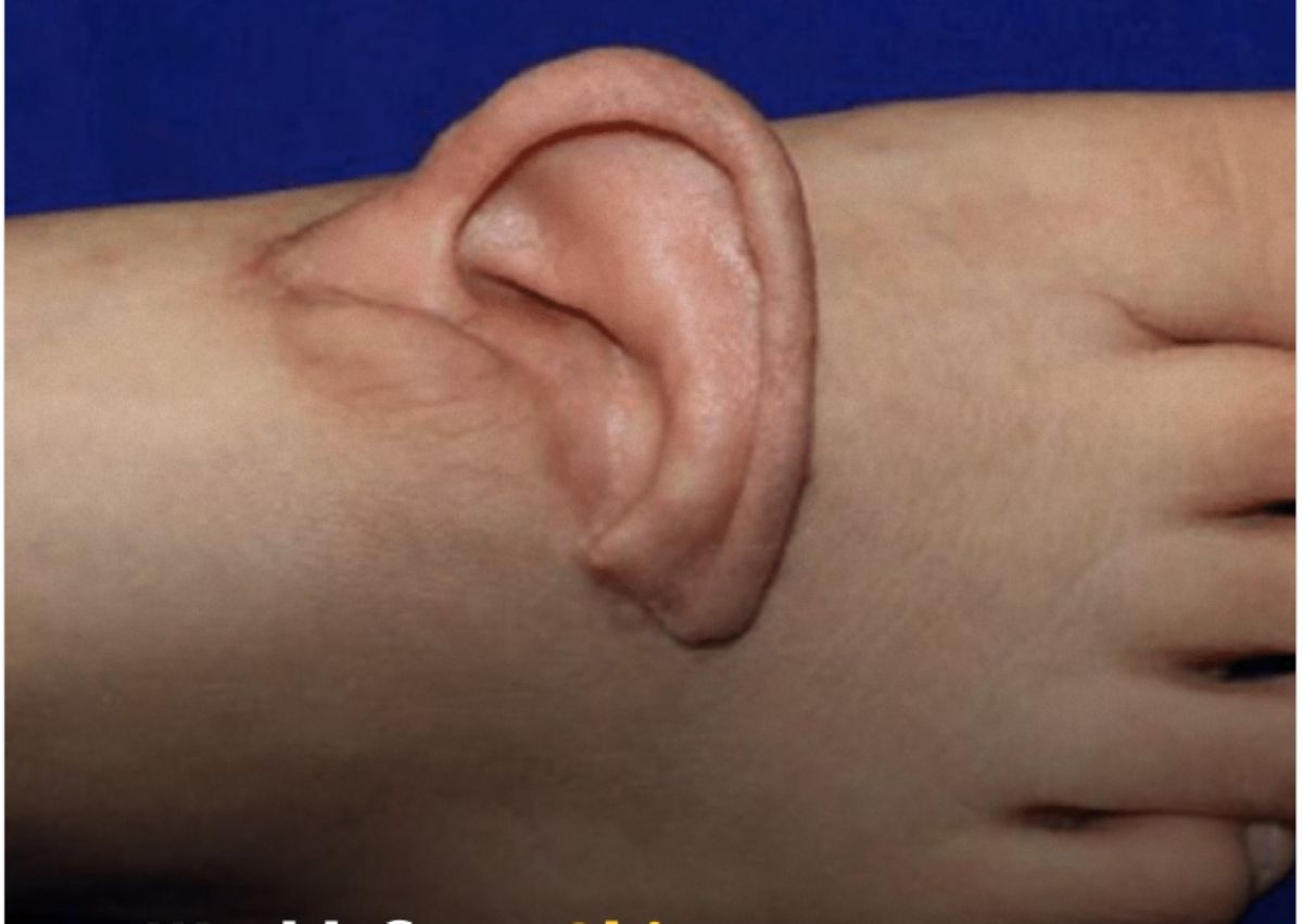 Ιατρική ομάδα στην Κίνα κατά τη διάρκεια της πρωτοποριακής μικροχειρουργικής επέμβασης μεταμόσχευσης αυτιού στο πόδι