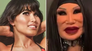 Η ηθοποιός Lyn May με παραμορφωμένο πρόσωπο μετά από αποτυχημένη πλαστική επέμβαση με επικίνδυνα υλικά