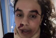 Η ηθοποιός Πηνελόπη Πλάκα με επαγγελματικό μακιγιάζ που προσομοιώνει τραύματα για τη σειρά του Mega