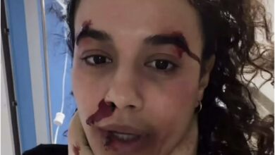 Η ηθοποιός Πηνελόπη Πλάκα με επαγγελματικό μακιγιάζ που προσομοιώνει τραύματα για τη σειρά του Mega